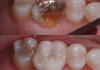 cadcam before & after