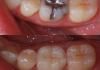 cadcam before & after