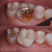 cadcam before & after