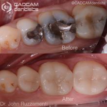 cadcam before & after