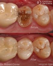 cadcam before & after